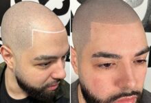 micro-scalp-pigmentation-nyc:-the-latest-trends-and-innovations-in-hair-restoration